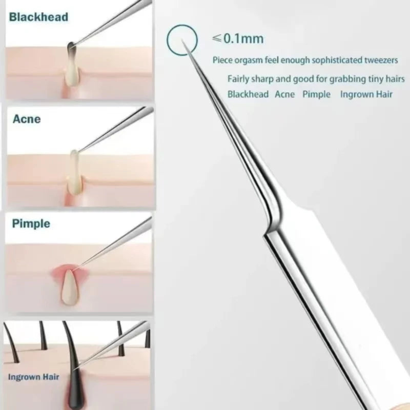 11Pcs Acne & Blackhead Removal Tool Set – Precision Ingrown Hair & Pore Cleaner